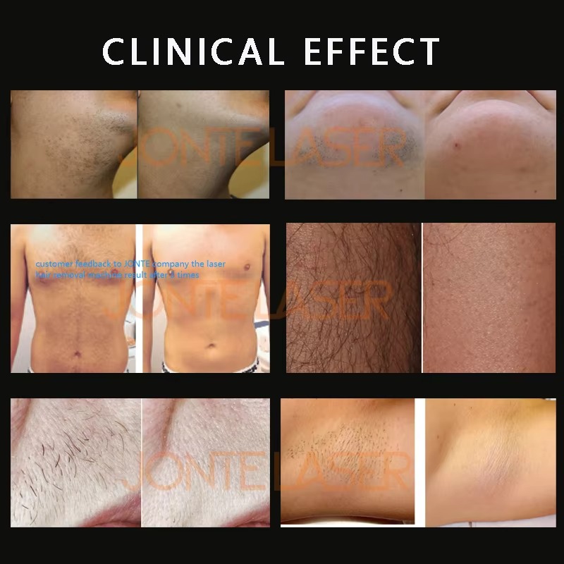เครื่องกำจัดขนด้วยเลเซอร์ไดโอด - Diode Laser Hair Removal 808Nm 755Nm 1064Nm บทวิจารณ์และราคา