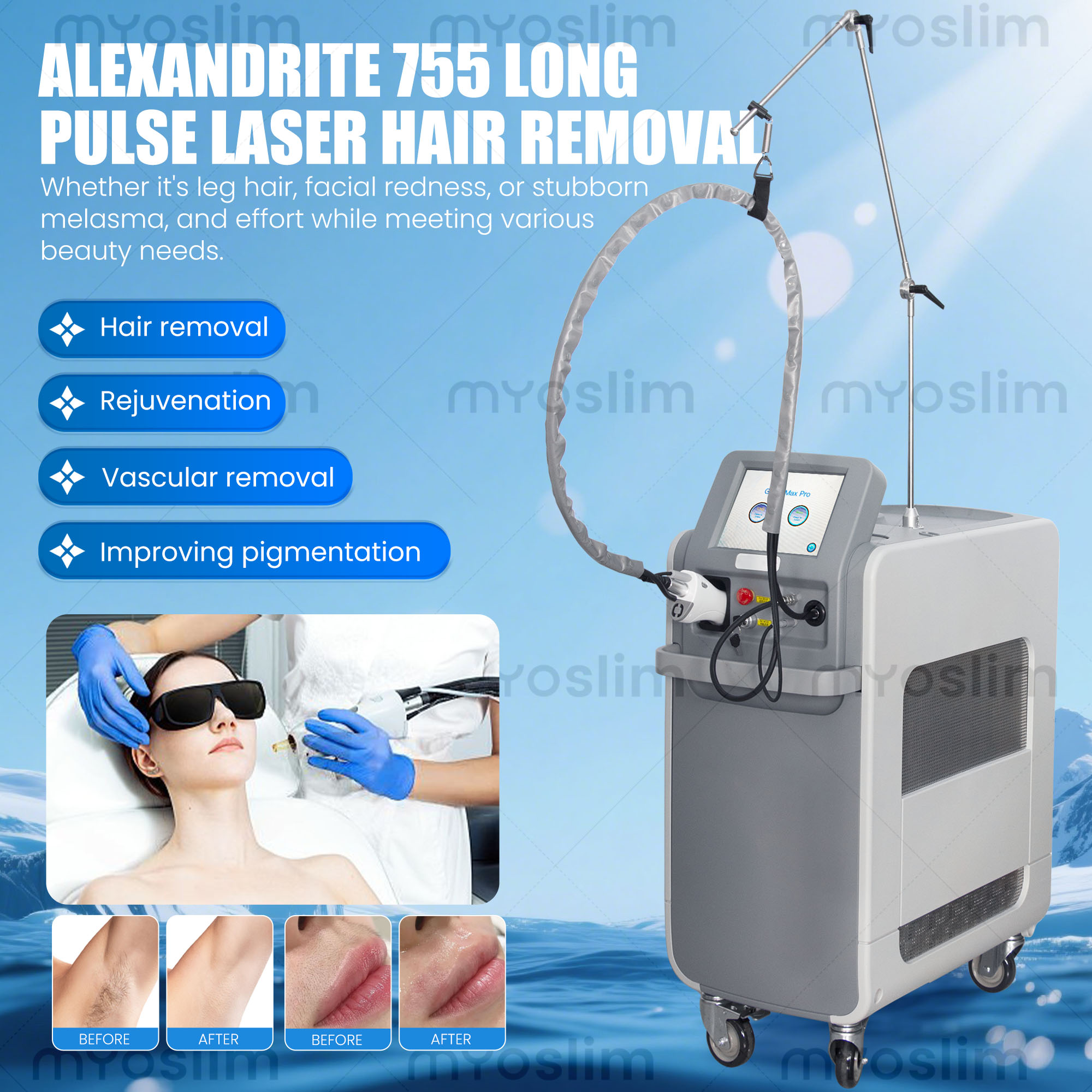เครื่องเลเซอร์ไฟเบอร์ออปติกแบบ - Alexandrite Laser Hair Removal Machine บทวิจารณ์และราคา