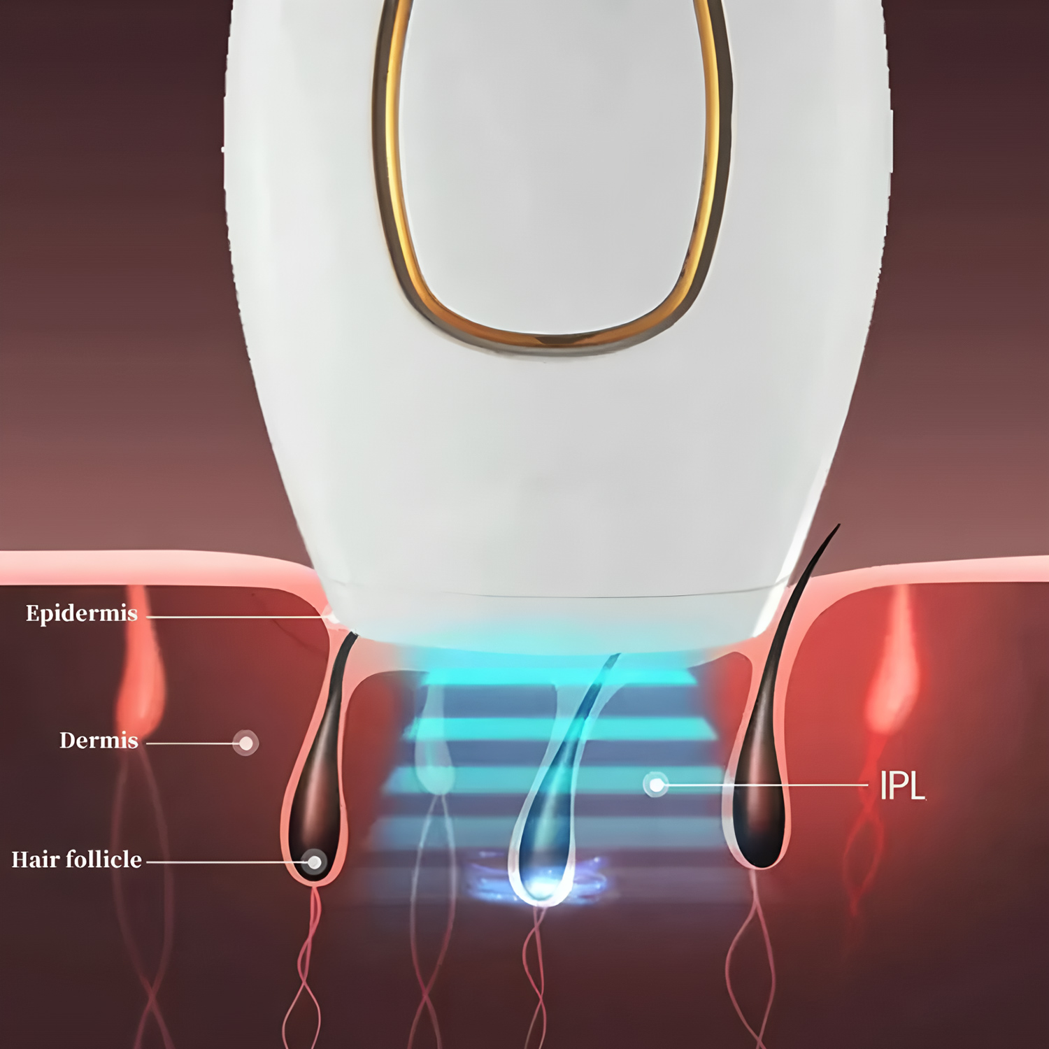 เครื่องกำจัดขนด้วยเลเซอร์ IPL  - Opt Ipl Laser Hair Removal Machine บทวิจารณ์และราคา